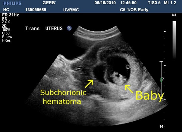 هماتوم در دوران بارداری